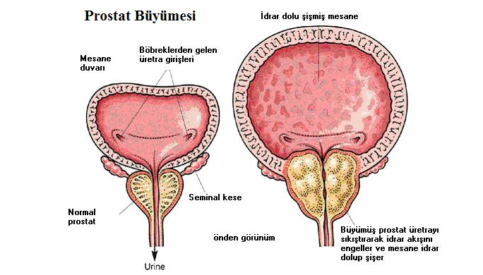 Prostat Bymesi